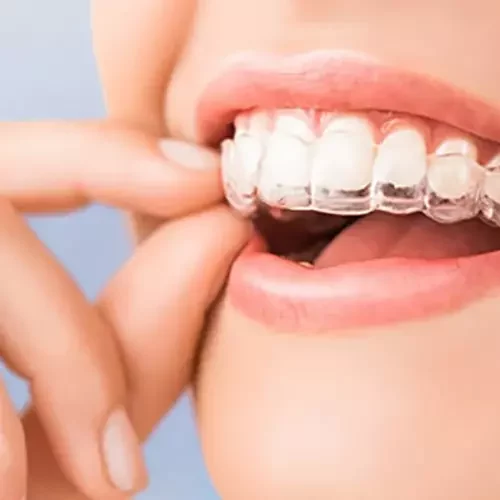 Alinhadores dentais | Araújo | Clínica Odontologia e Estética | Dentista | Maceió | Alagoas